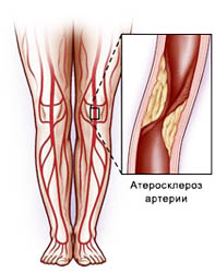 Изображение 2: Атеросклероз сосудов нижних конечностей - клиника Семейный доктор